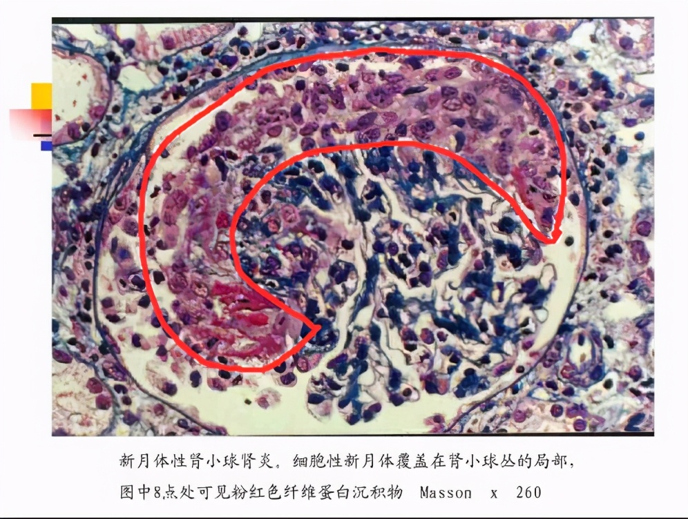 细胞性新月体恢复需要多长时间