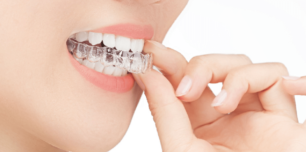 以前补过牙 可以隐形矫正吗 需要注意什么问题 牙齿