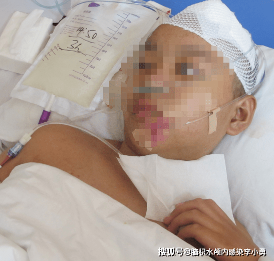 脑外伤术后偏瘫和脑脊液鼻和耳漏，腰大池引流又致难治性颅内感染和脑积水