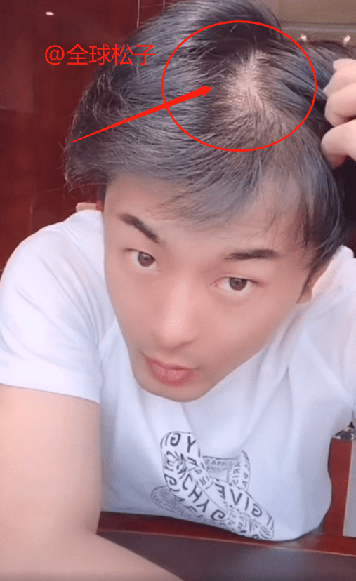 原创压力太大辛巴直播暴露发量头发稀少疑似秃顶