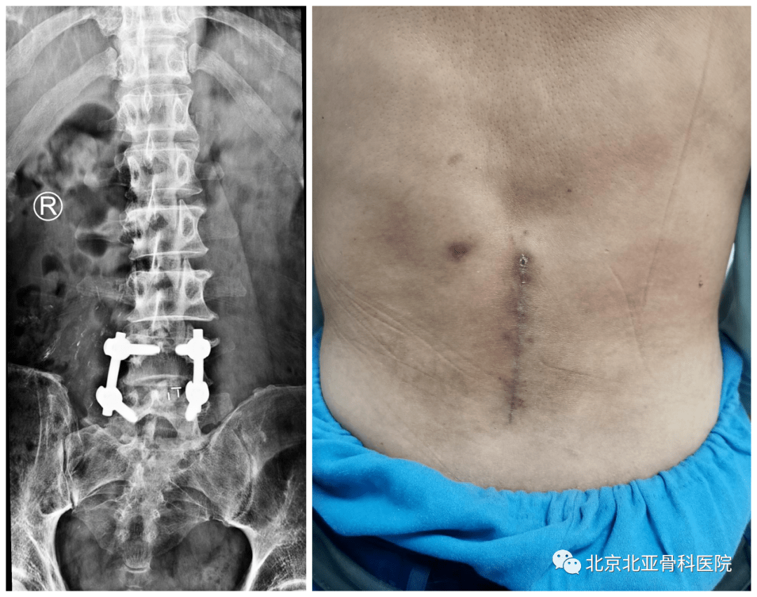 第三节 椎管内突出型腰椎间盘突出症（盘内技术）