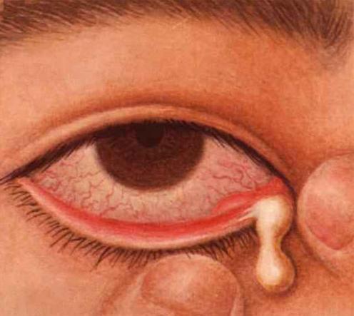 同样是肿急性泪囊炎与麦粒肿有什么不同