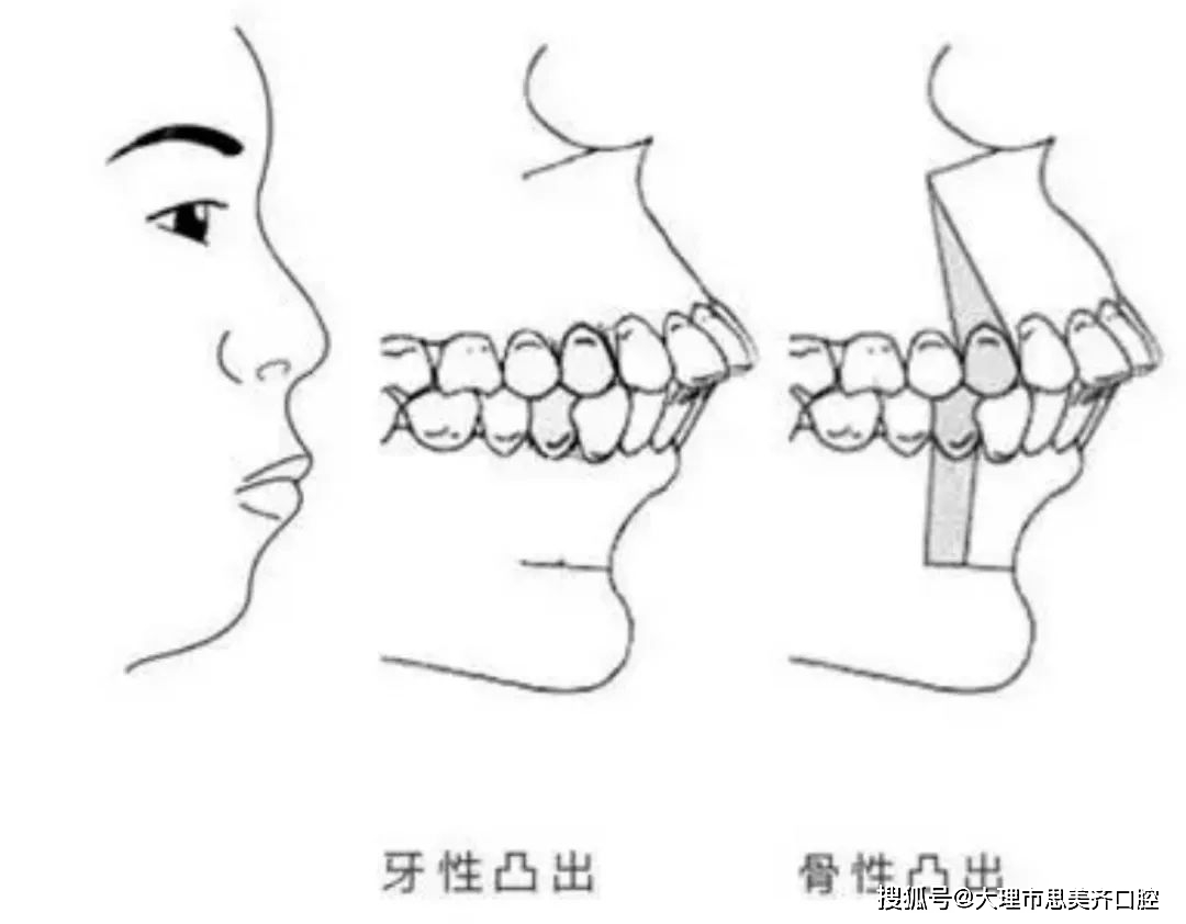 没下巴的人 可能真的不是因为胖 牙齿