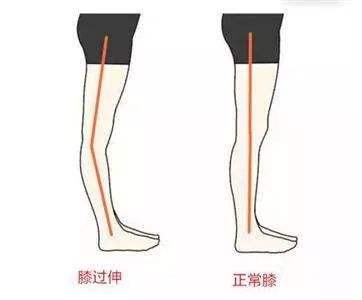 医生我父亲能走了但是为啥膝关节反弓了陈金明医生这是膝过伸