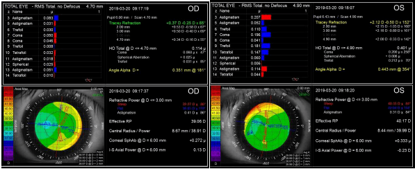图4:配戴rgp后双眼itrace检查像差情况图5:配戴rgp后双眼itrace检查