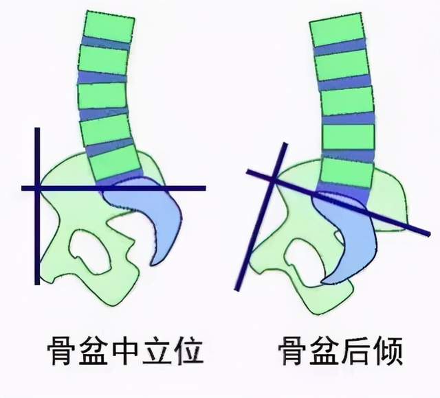 腰痛 屁股扁平 大肚子 原来是骨盆后倾惹的祸 肌肉疲劳