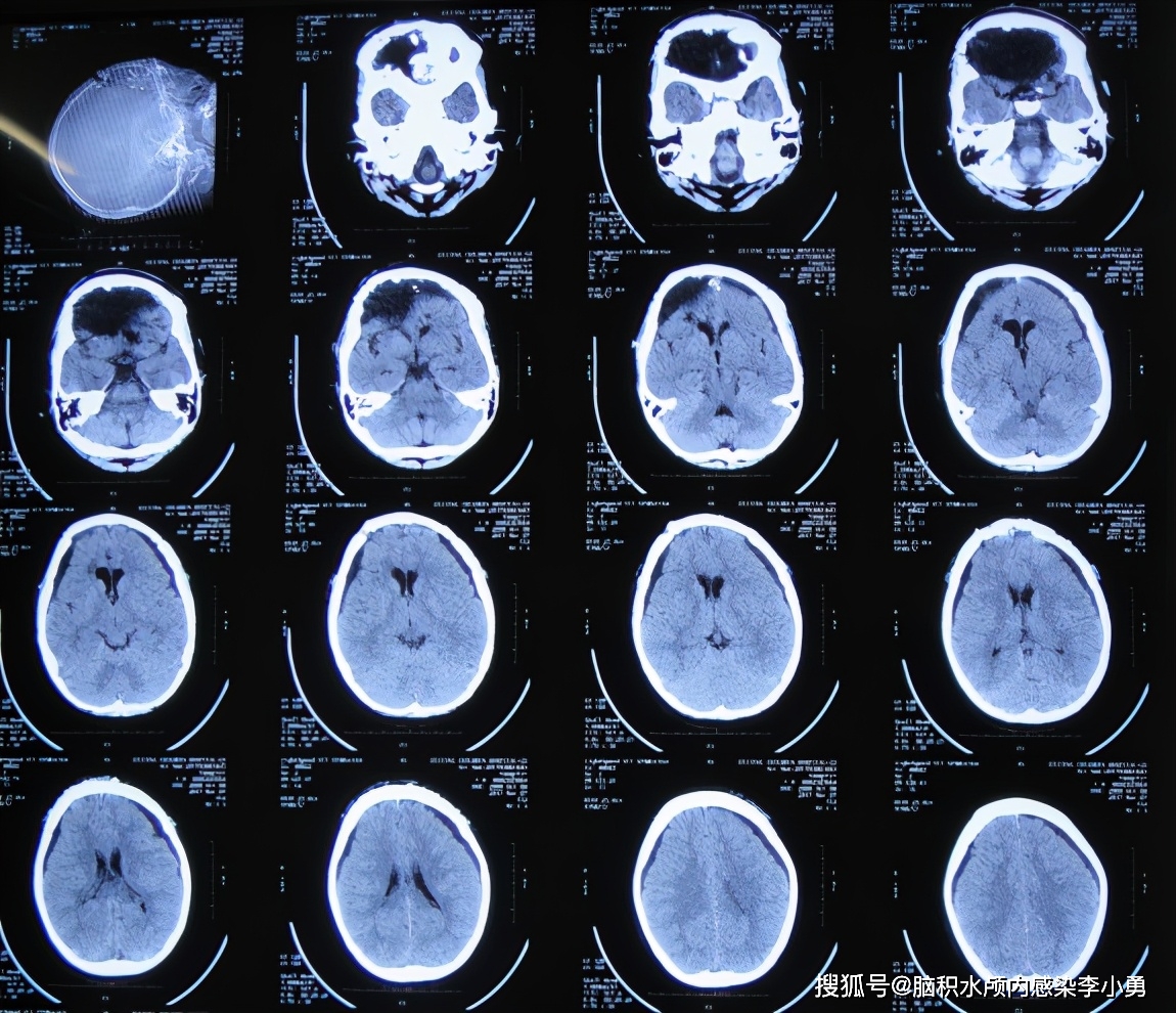 顱腦外傷後腦脊液鼻漏4年餘內3次腦脊液漏修補術和1次開顱術後顱內