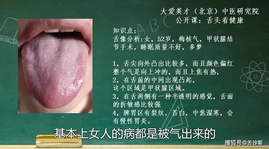 舌象分析 梅核气 爱生气的女性 失眠 多梦 容易焦虑 频道 手机搜狐