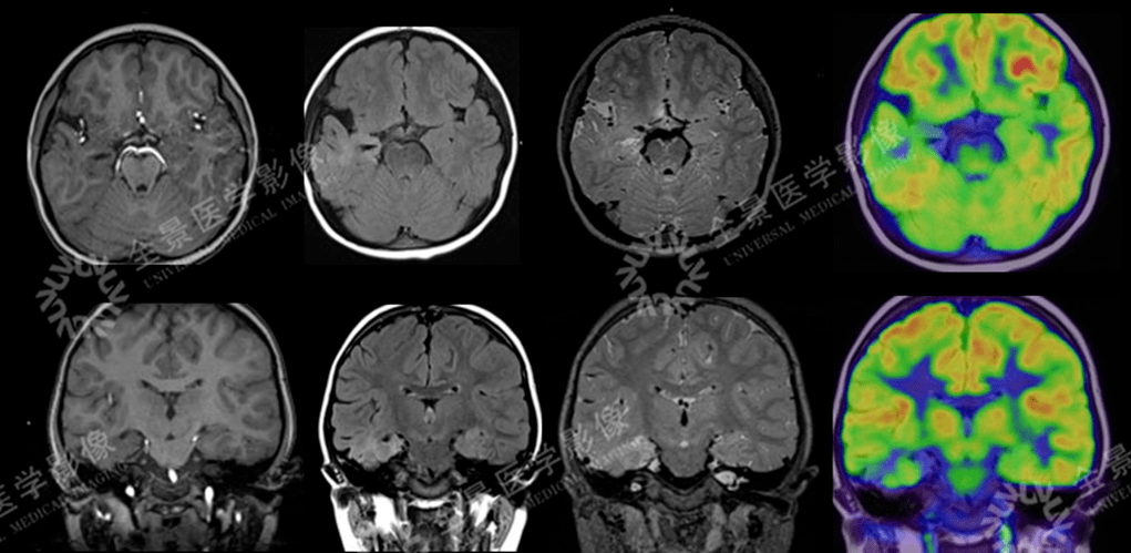 2 歲,發作性癲癇1月mri未發現明確病灶pet/mr示左側前額葉fdg代謝減低