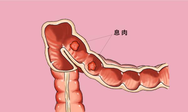 胃肠息肉到底要不要切除