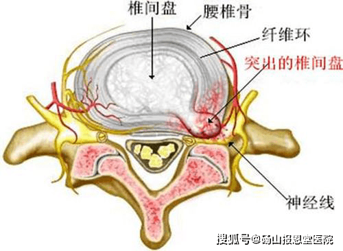 什么是游离骨 4a12055caf324987a672ea790bb5a836.png