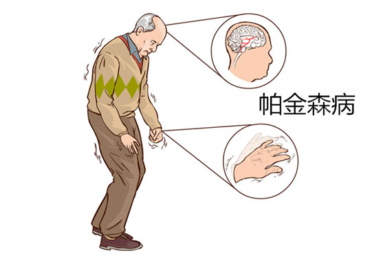 帕金森患者步态异常该怎么办医生两个动作就能搞定
