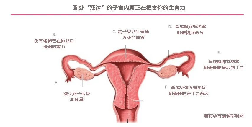 子宫内膜异位症会带来生育力的下降