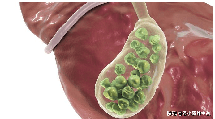 胆囊手术后饮食注意 c66f98ebdb8d4439be3e229b7f88ae79.png