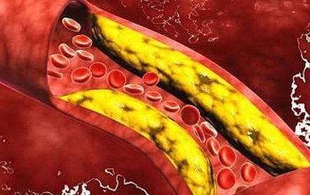 吃什么东西能软化血管降血脂 b080988b766744ee801e2c5fb1f2edd8.jpeg