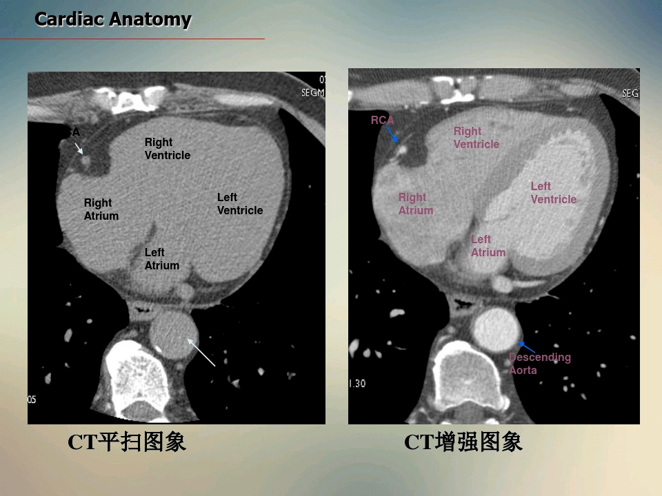 心臟ct斷面解剖