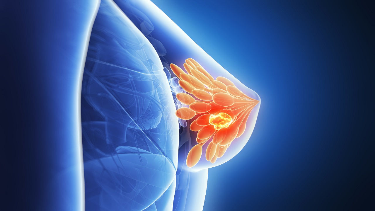 乳腺癌幸存者更有可能患上新的癌症