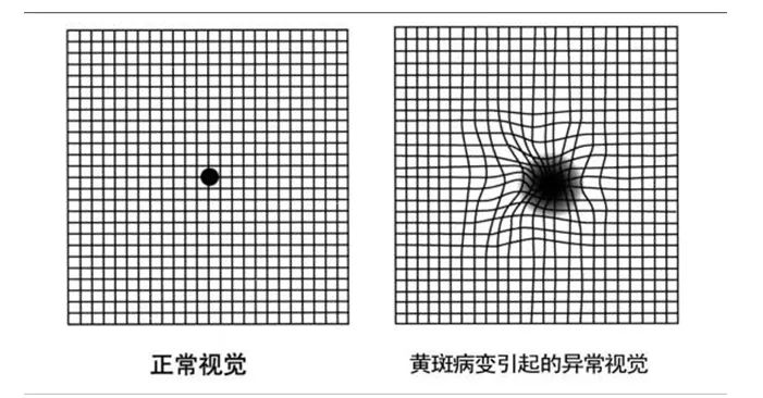 等屏幕的背景光)进入眼睛会产生大量自由基,导致白内障,黄斑区退化