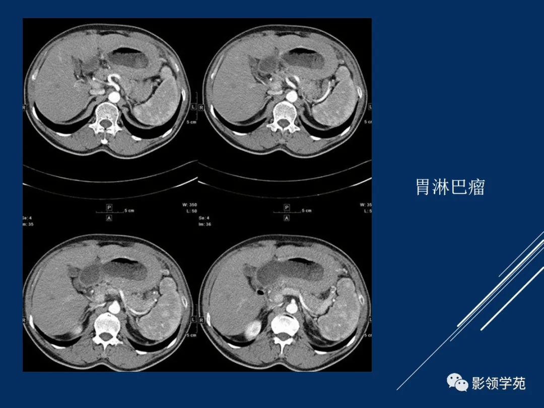 15個病例熟悉胃腸道間質瘤影像表現