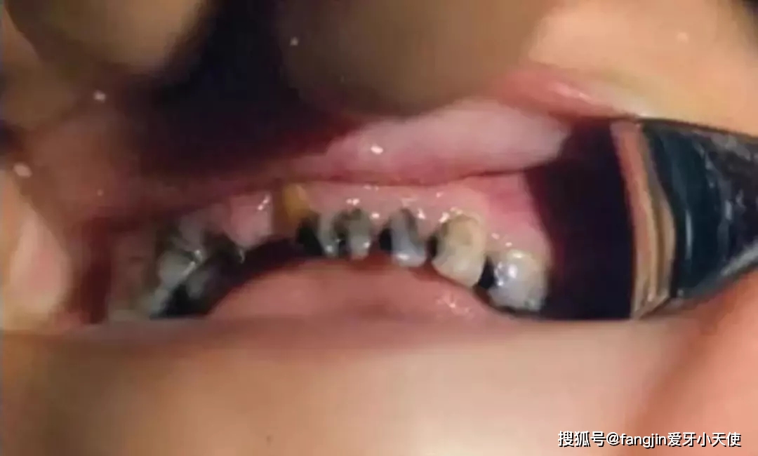 几个月出第5颗牙齿 86d97c4029024caea1a8ab57a4fc7c86.jpeg