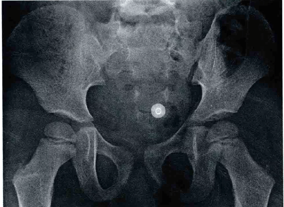 骨盆正位x線平片中,黑線勾勒出右半骨盆及股骨近端的初級骨化中心.