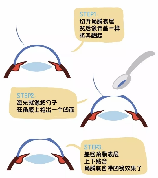 激光近视手术和晶体植入的区别 48f0dd1c57ba48769f2de2918d8a55f3.jpeg