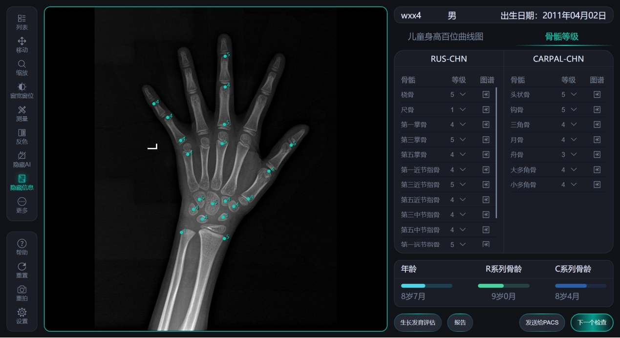 如何讓測骨齡像量血壓一樣簡單