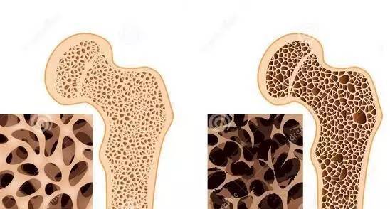 研究骨骼34年,69岁院士:除了肥肉,2素也易加速骨丢失,劝少吃