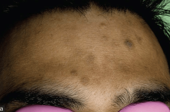 炎症后色素沉着通常表现为棕色或褐色的痘印