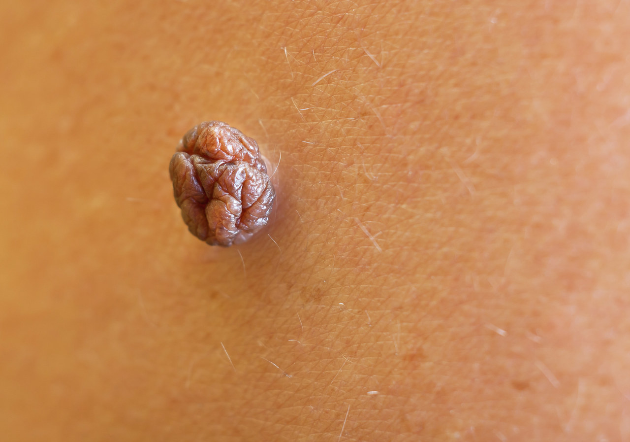 什么是疣?应该如何预防?