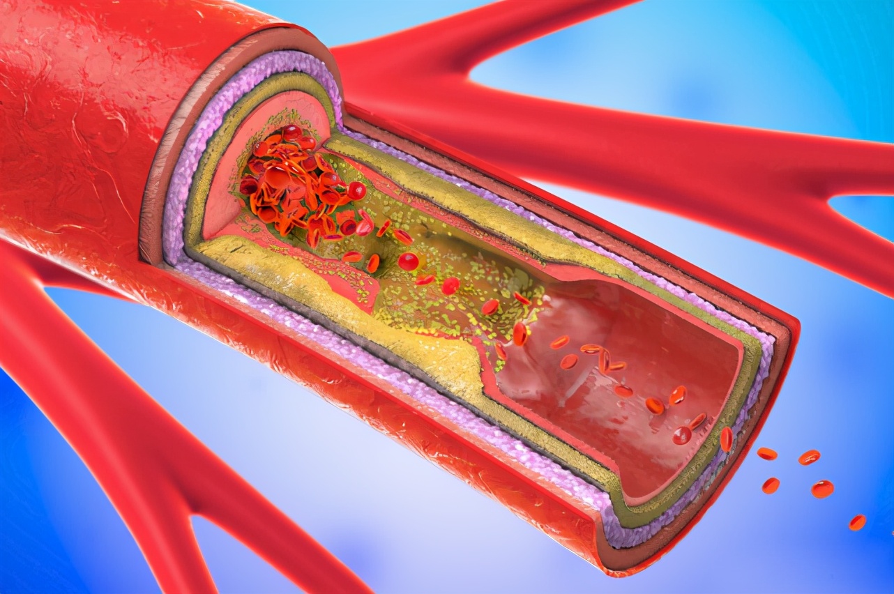 高血压"罪魁祸首"并不是盐,而是它!怪不得血压降不下