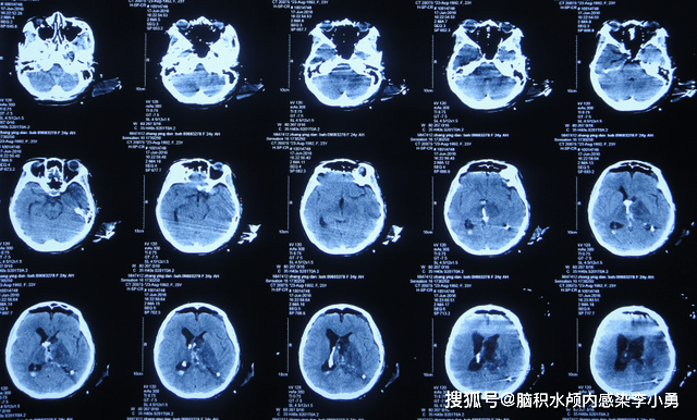 脑室内脑膜瘤切除术后继发脑积水颅内感染脑室粘连命名性失语