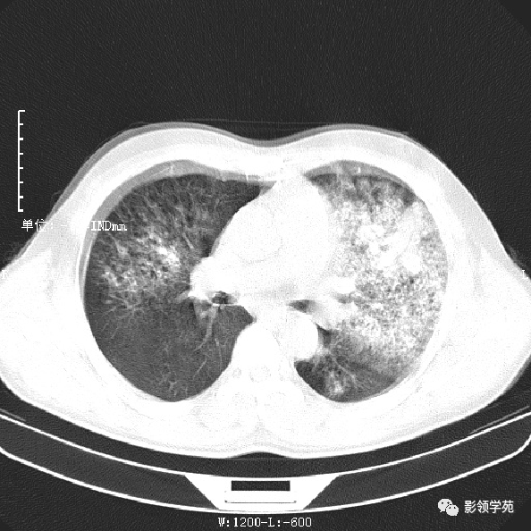军团菌肺炎的影像诊断