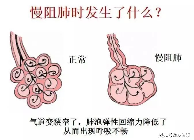 慢阻肺患者