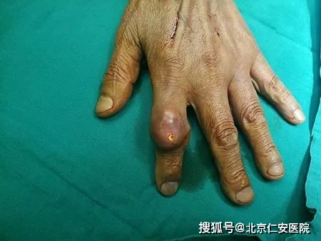 如何判断自己是否痛风参考以下指标