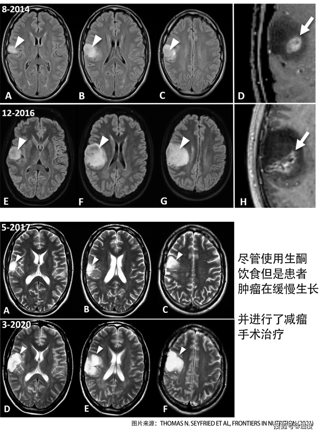原创生酮饮食帮助患者对抗脑癌长达82个月