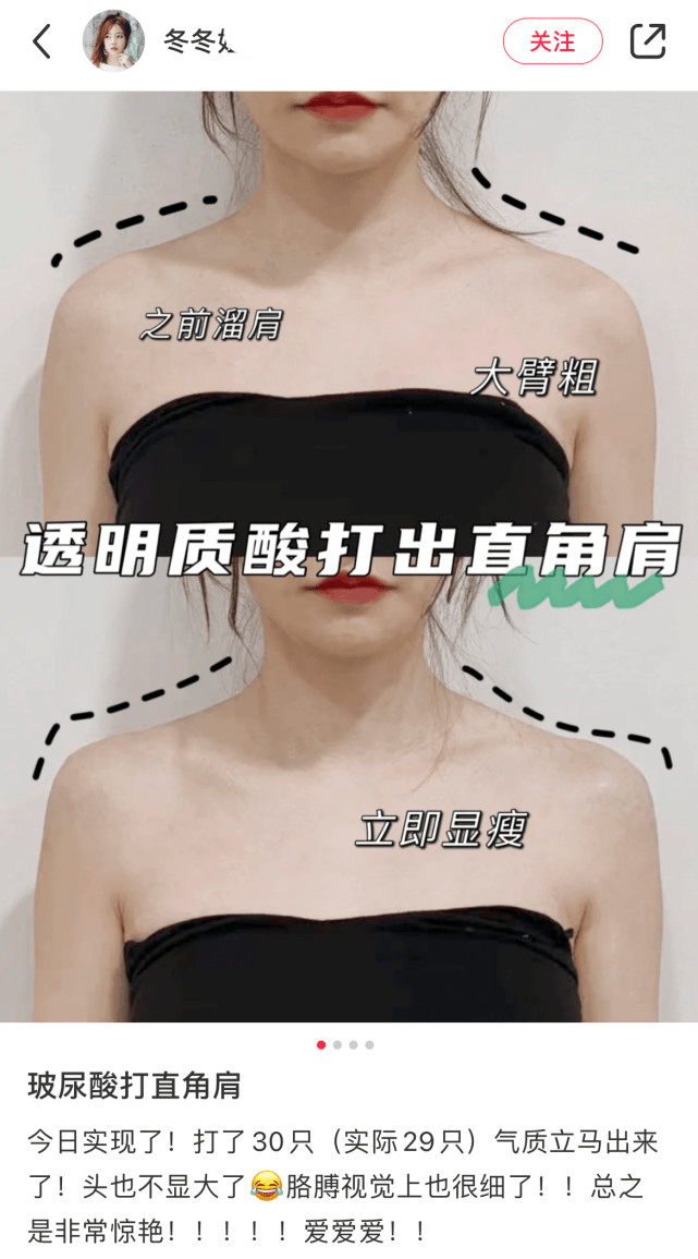 不少医美机构表示,由于瘦肩针只是针对斜方肌,所以如果想要直角肩的