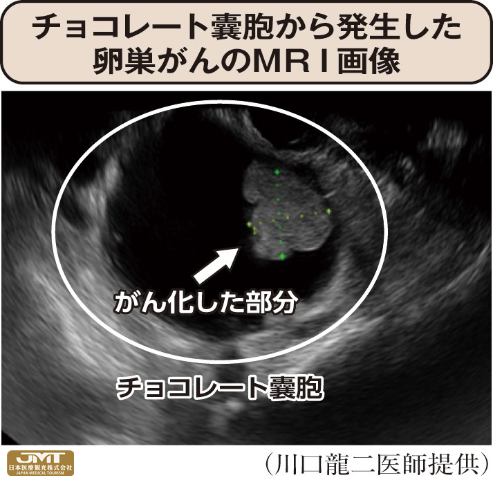 jmt日本醫療巧克力囊腫可能導致卵巢癌不要認為只是痛經就一味忍耐