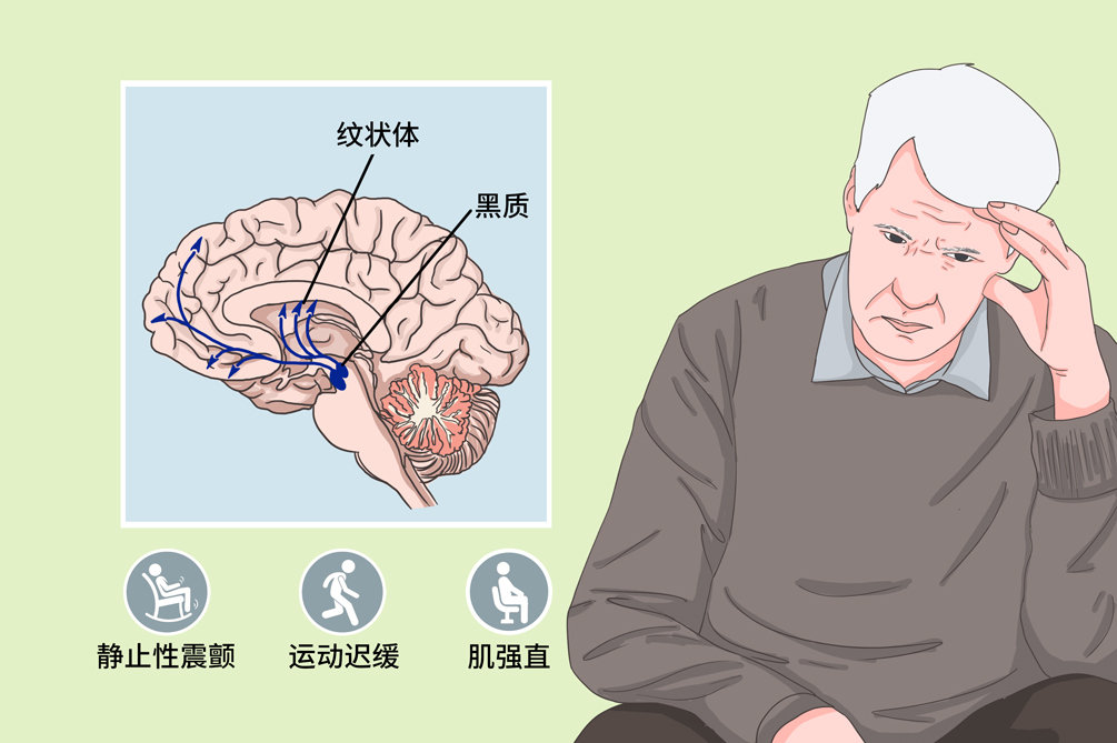帕金森病为什么紧张激动时会加重_症状