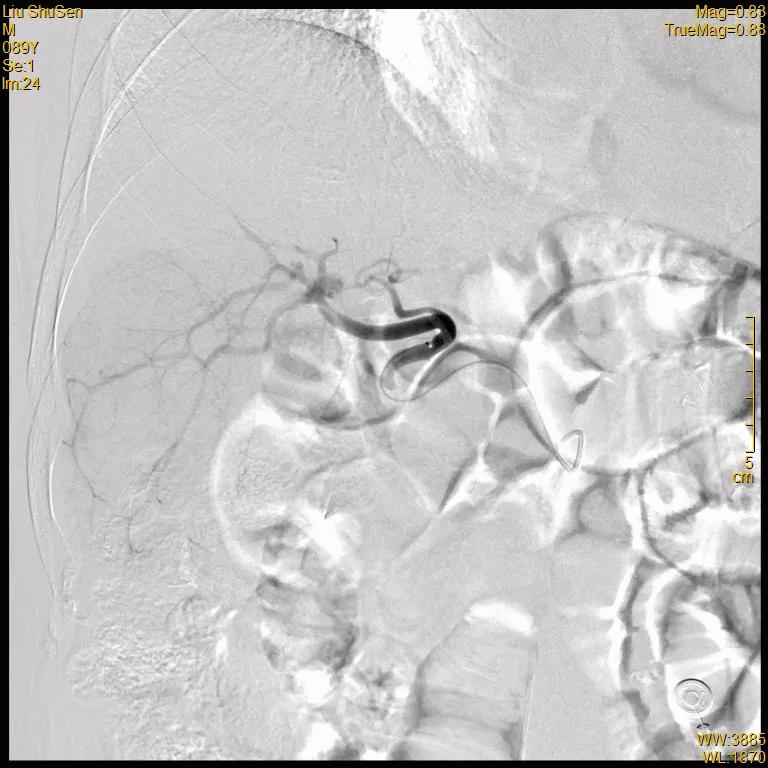 患者|高龄患者得肝癌就要放弃治疗？介入医生说“NO”！