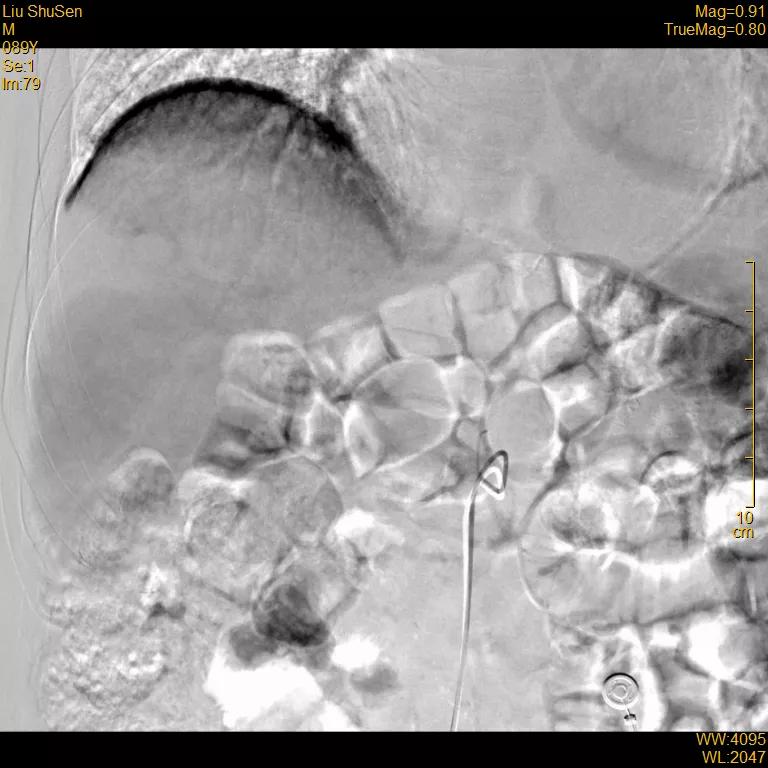 患者|高龄患者得肝癌就要放弃治疗？介入医生说“NO”！