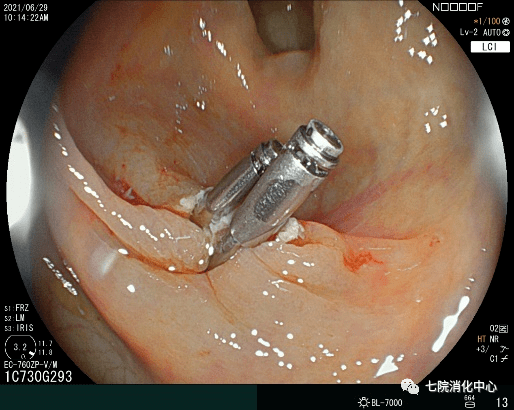 手术|结肠息肉怎么破？内镜帮您来搞定