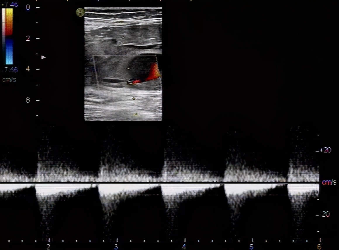 夹层|真性动脉瘤、假性动脉瘤、夹层动脉瘤特点及表现