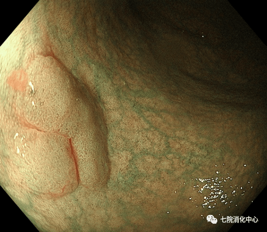手术|结肠息肉怎么破？内镜帮您来搞定