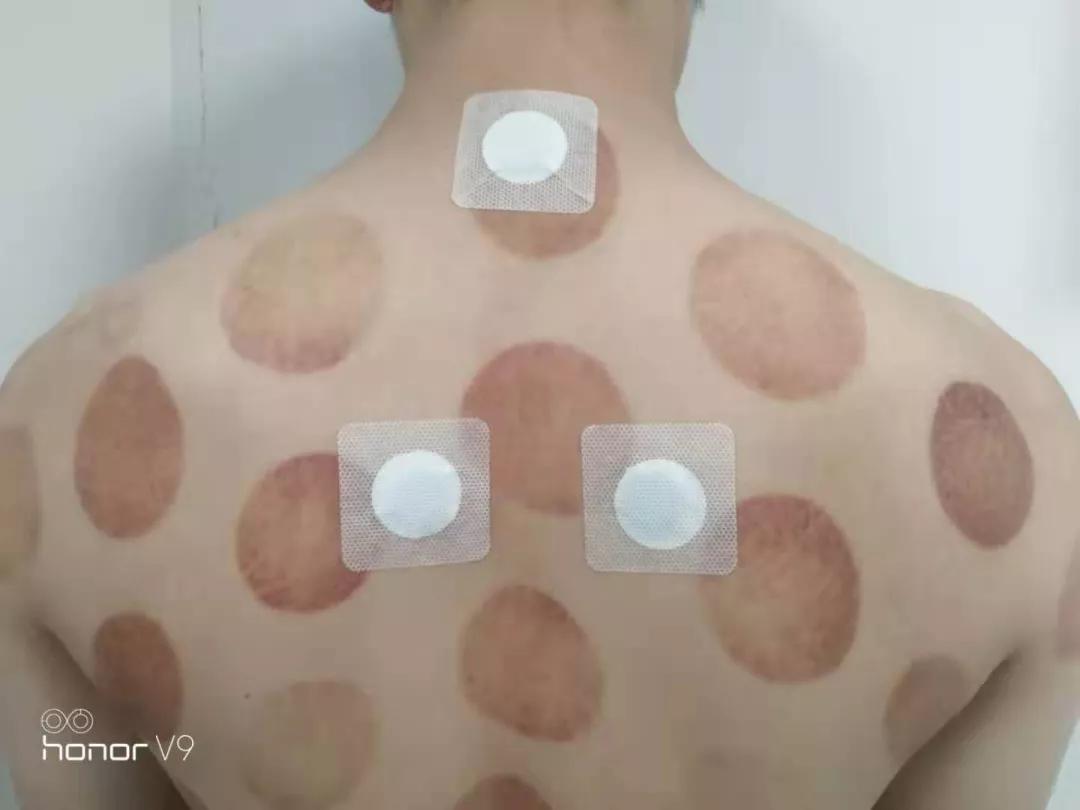 医保|北京老年医院“三伏贴”开始预约啦！