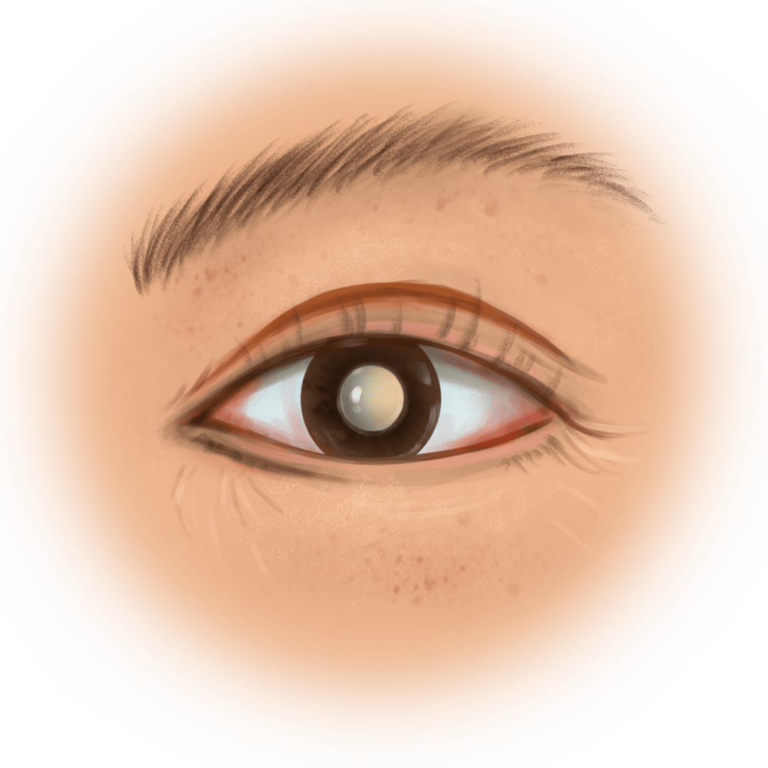 生活|【爱眼护眼69】白内障手术人工晶体怎么选？