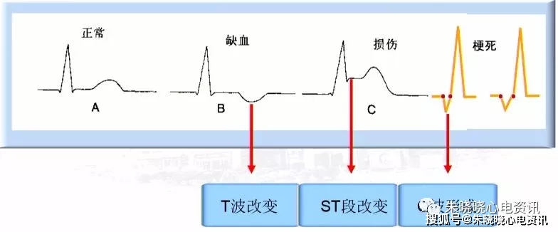 acs心電圖診斷與罪犯血管預判