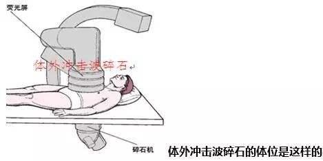 肾脏|得了肾结石，去年打了一次，现在还能再打？医生给您一次性说清楚