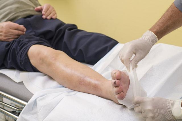 糖尿病人|刘院长：糖尿病人热水泡脚会加重？泡脚谨记这三点