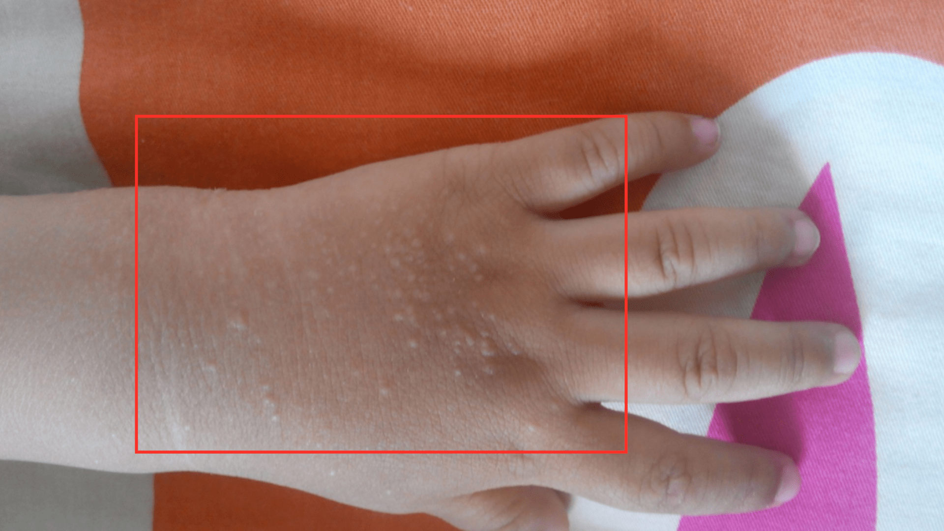 解说|为什么气温越高，湿气越重？医生来解说